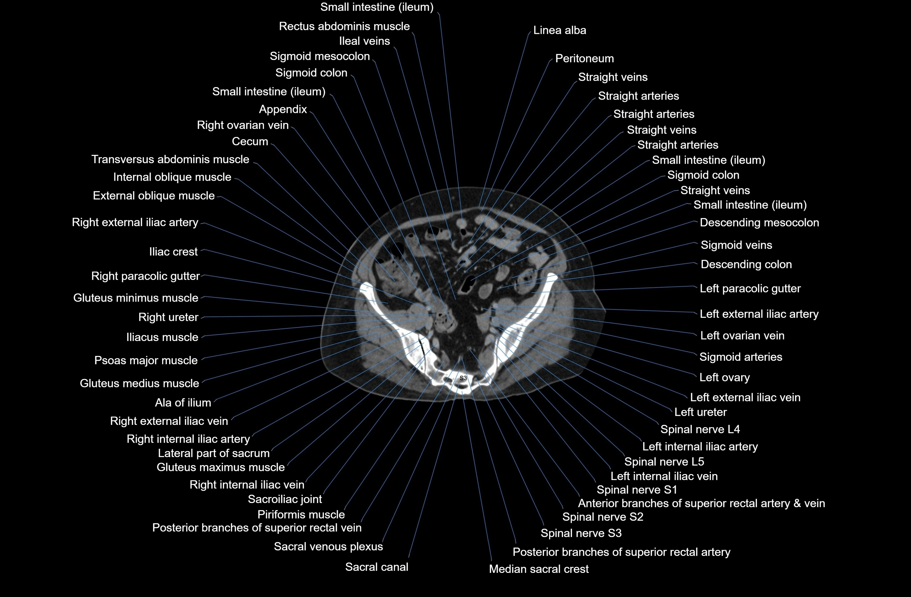 CT Abdomen axial cross sectional anatomy labelled radiology image-00073.webp